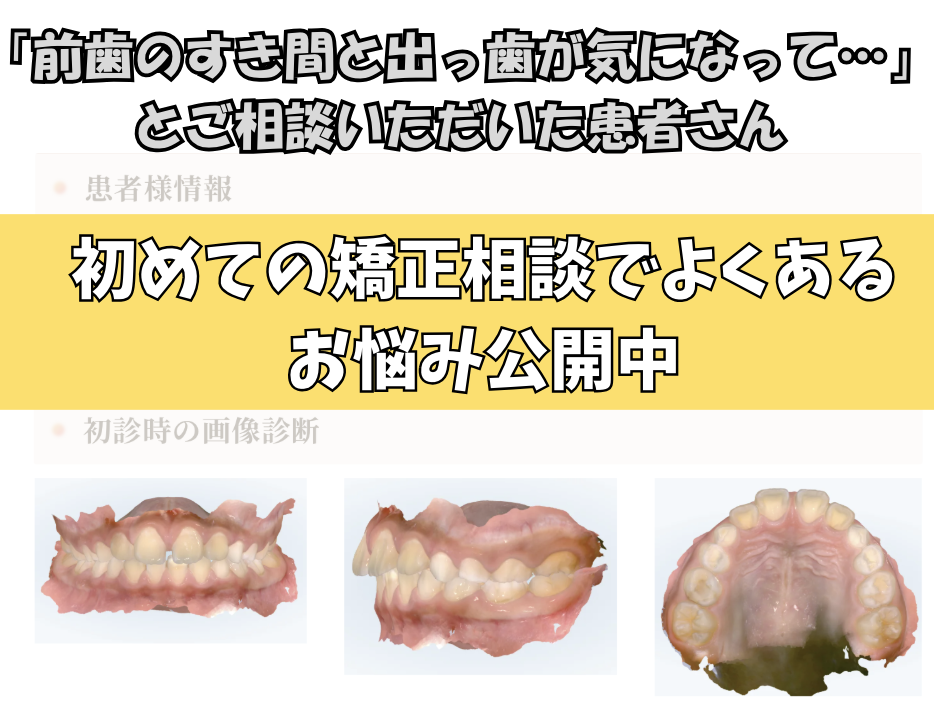 「前歯のすき間と出っ歯が気になって…」とご相談いただいたI.Mさん（8歳・男の子）のケース