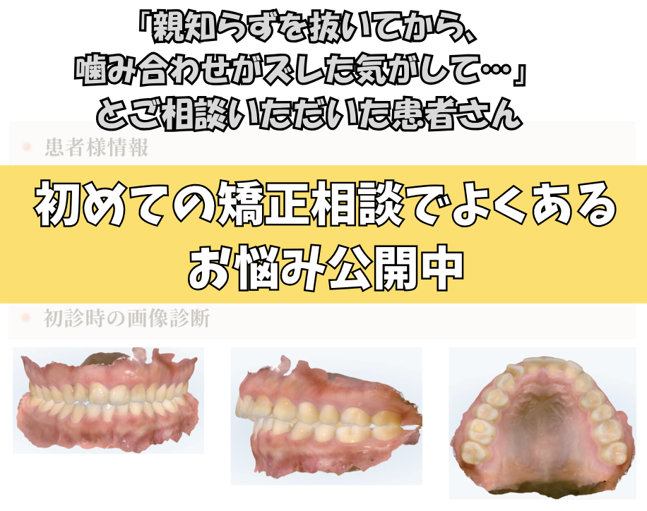 「親知らずを抜いてから、噛み合わせがズレた気がして…」とご相談いただいたH.Tさん（25歳・女性）のケース