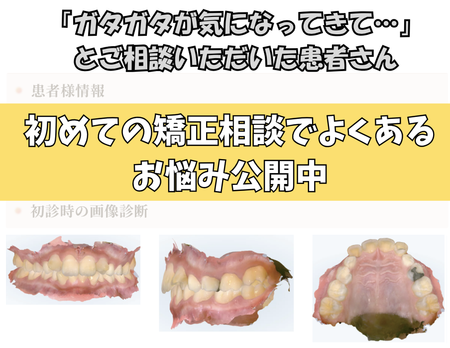 「ガタガタが気になってきて…」とご相談いただいた9歳・男の子のケース