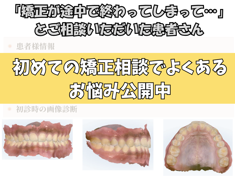 「矯正が途中で終わってしまって…」とご相談いただいたS.Sさん（17歳・男の子）のケース