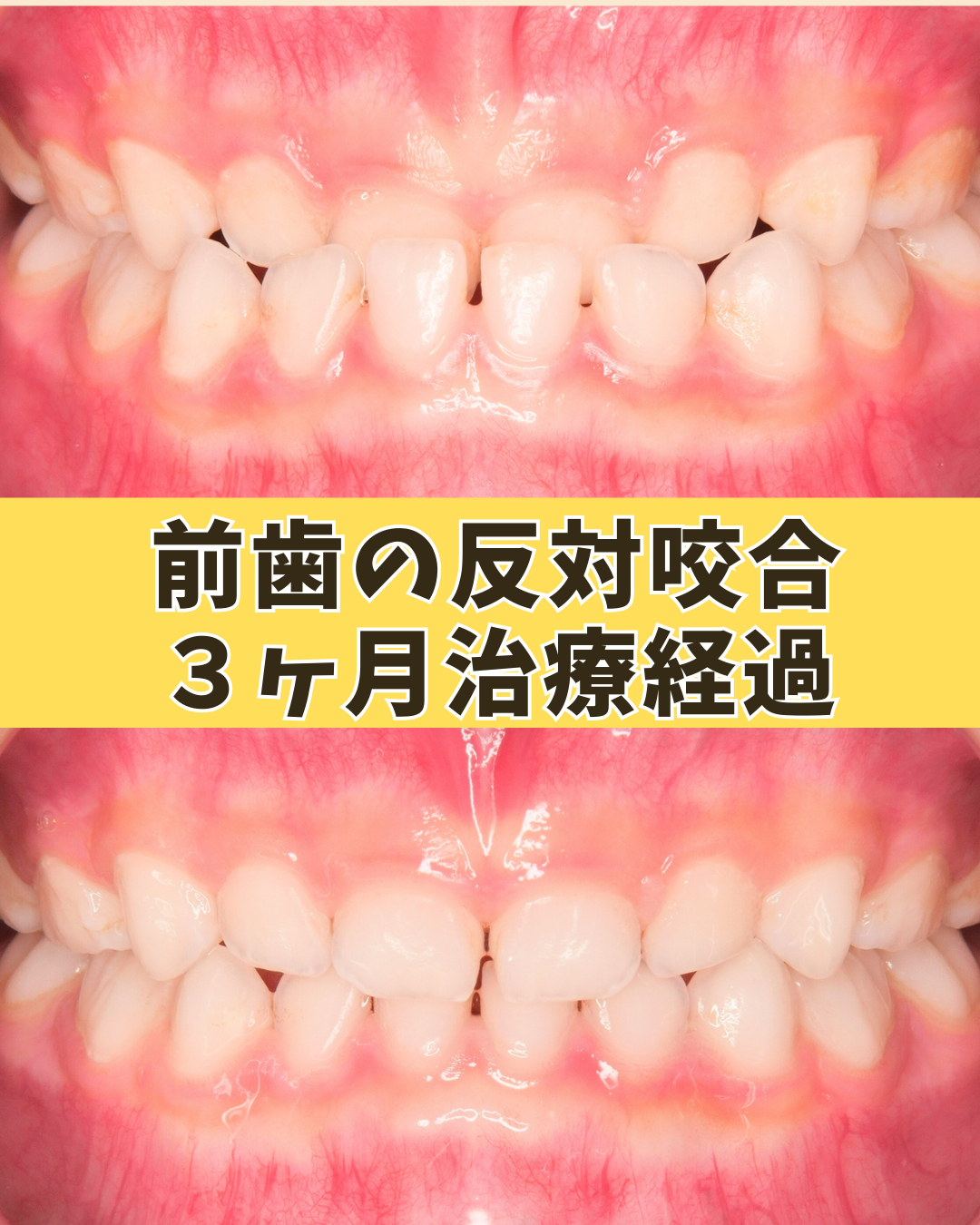 6歳(治療経過)｜反対咬合で上の前歯が見えないと気になっていたケース