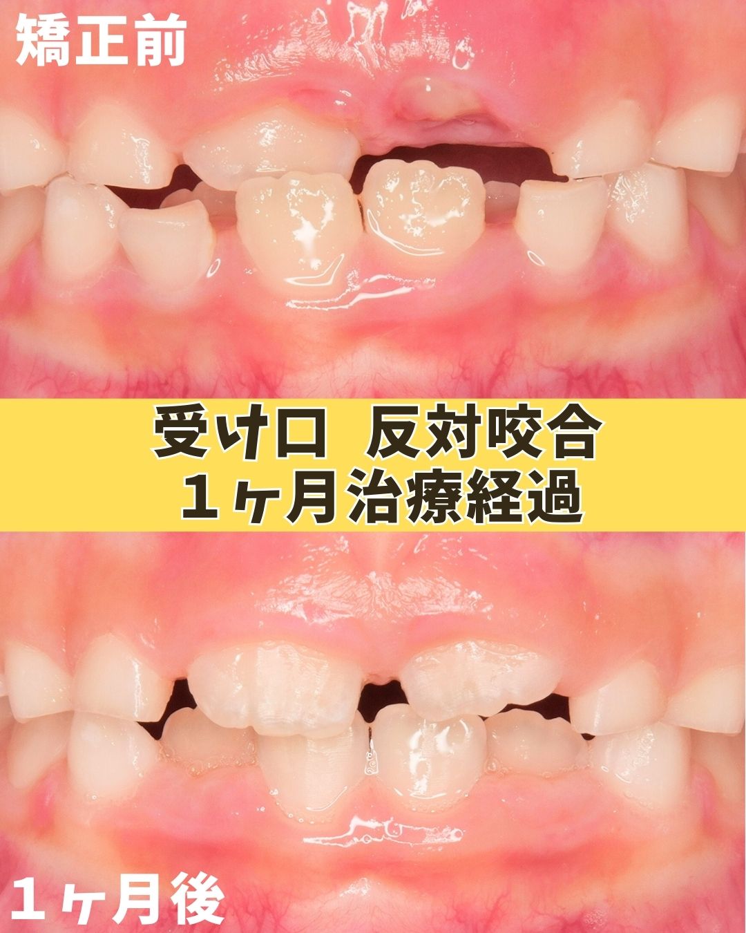 小学校低学年(治療経過)｜反対咬合と受け口が気になっていたケース