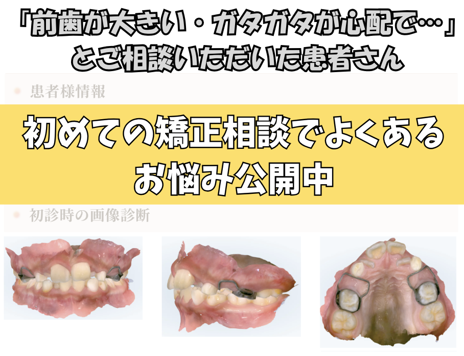 「前歯が大きい・ガタガタが心配で…」とご相談いただいたT.Nさん（9歳・男の子）のケース