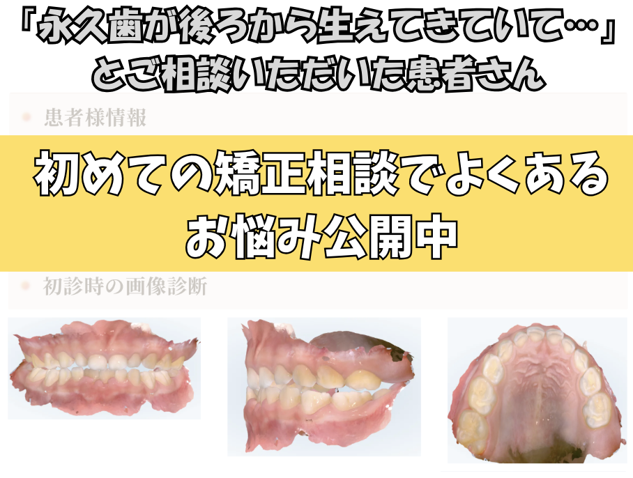 「永久歯が後ろから生えてきていて…」とご相談いただいたH.Sさん（5歳・男の子）のケース