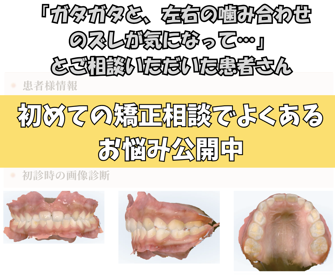 「ガタガタと、左右の噛み合わせのズレが気になって…」とご相談いただいたK.Yさん（8歳・女の子）のケース