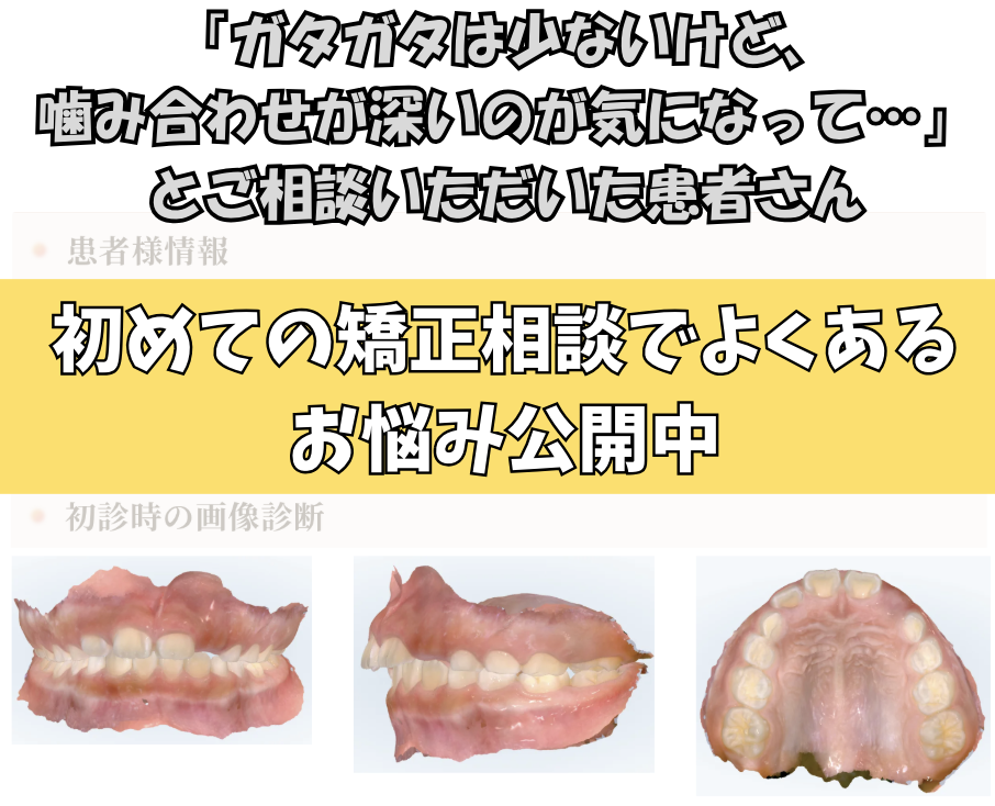 「ガタガタは少ないけど、噛み合わせが深いのが気になって…」とご相談いただいた 7歳・女の子のケース