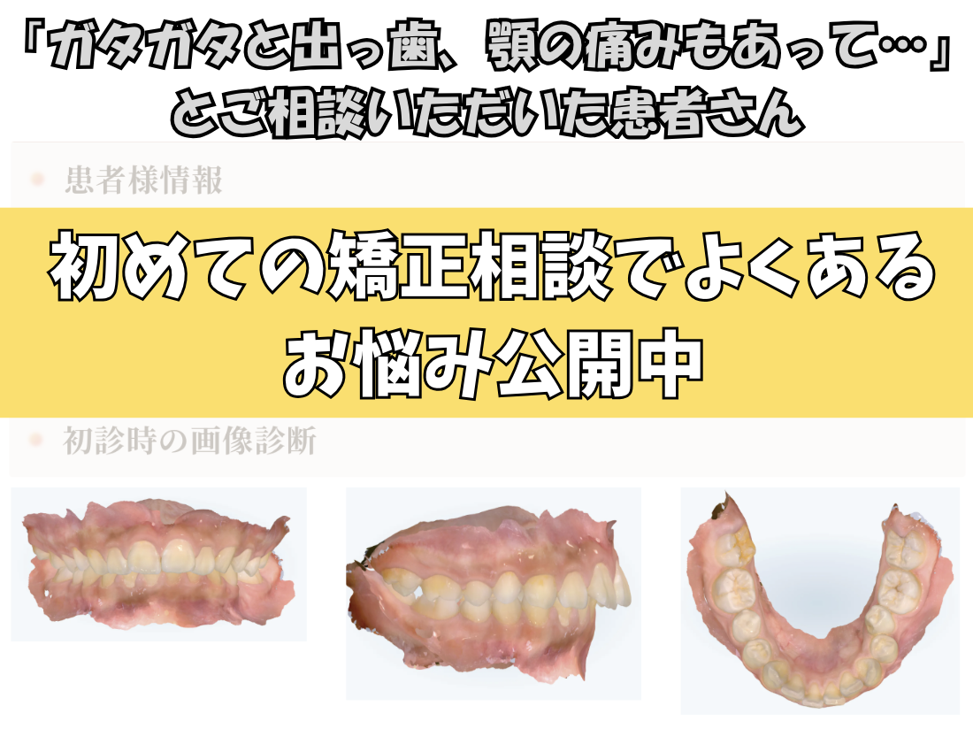 「ガタガタと出っ歯、顎の痛みもあって…」とご相談いただいたNさん（14歳・女の子）のケース