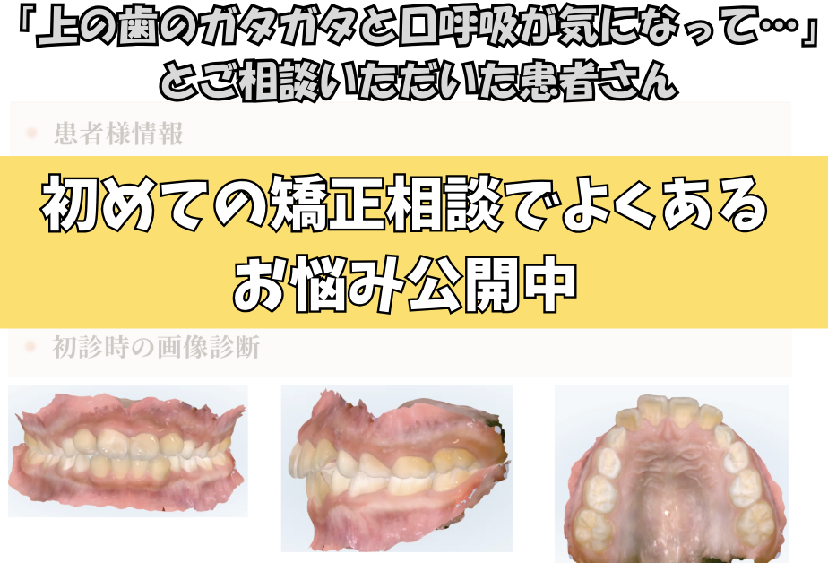 「上の歯のガタガタと口呼吸が気になって…」とご相談いただいたR.Tさん（9歳・男の子）のケース