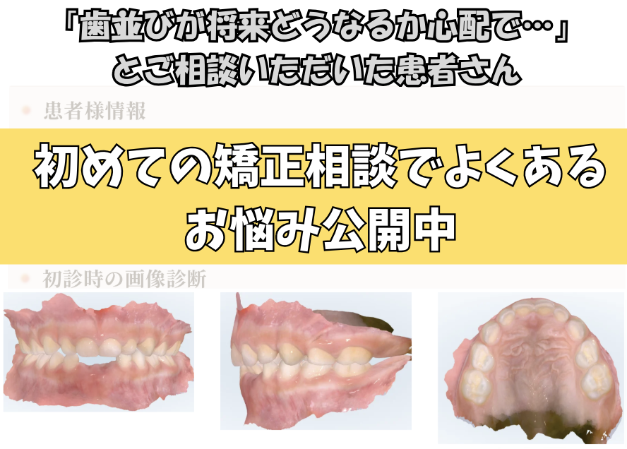 「歯並びが将来どうなるか心配で…」とご相談いただいたT.Nさん（5歳・女の子）のケース