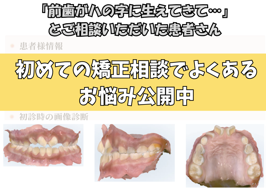 「前歯がハの字に生えてきて…」とご相談いただいたA.Uさん（8歳・女の子）のケース