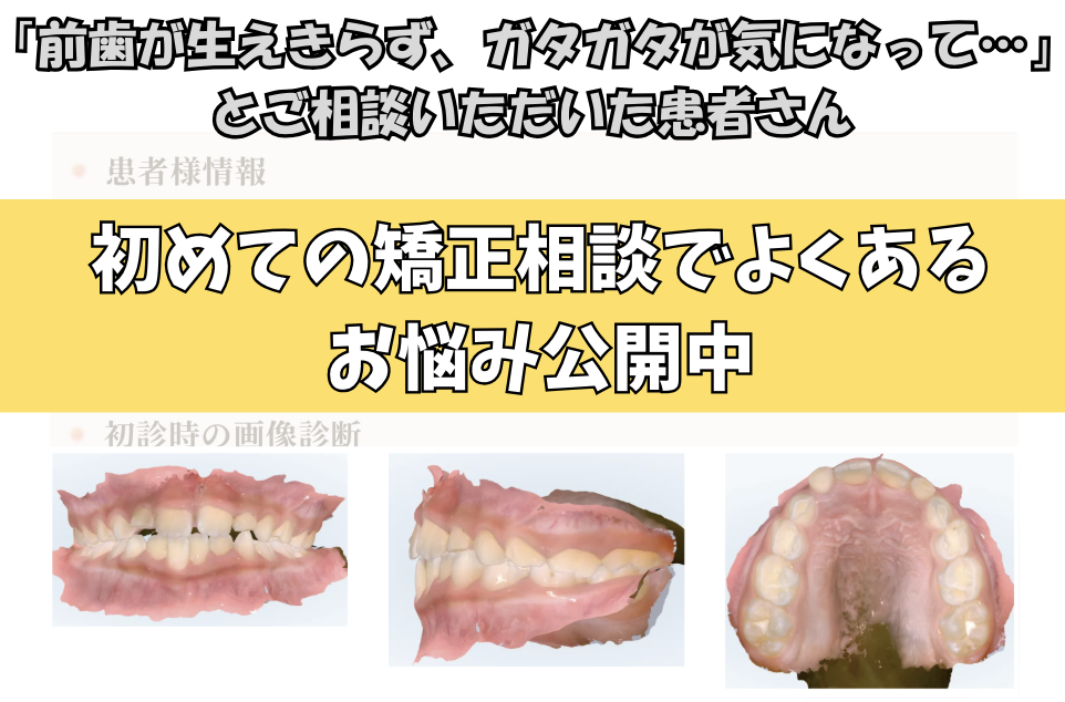 「前歯が生えきらず、ガタガタが気になって…」とご相談いただいたF.Iさん（7歳・女の子）のケース