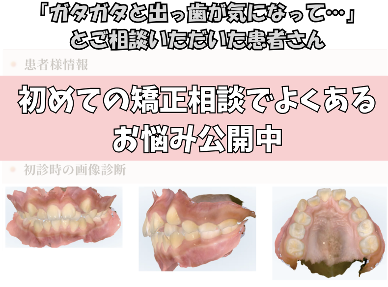 「ガタガタと出っ歯が気になって…」とご相談いただいたS.Iさん（10歳・女の子）のケース