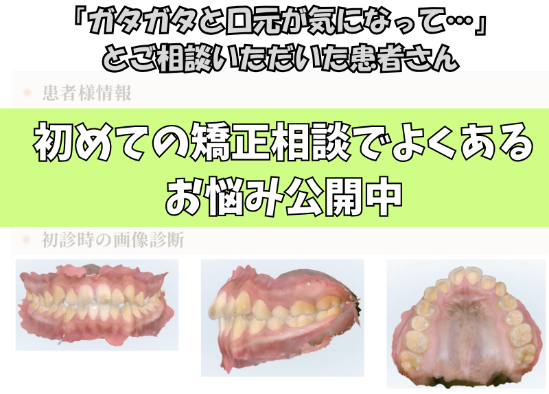 「ガタガタと口元が気になって…」とご相談いただいたS.Oさん（12歳・男の子）のケース