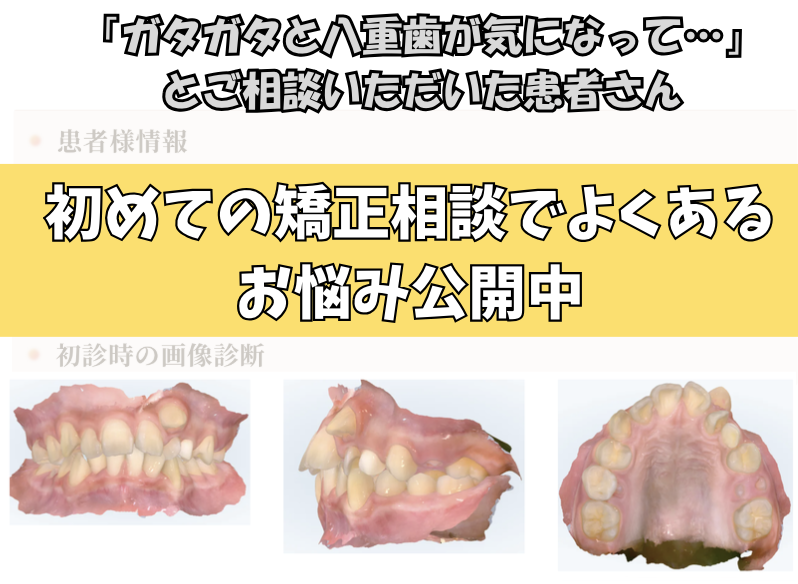 「ガタガタと八重歯が気になって…」とご相談いただいたK.Tさん（12歳・男の子）のケース