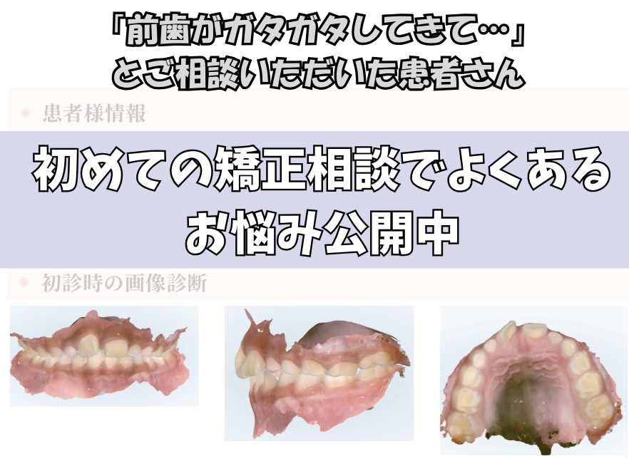 「前歯がガタガタしてきて…」とご相談いただいたK.Hさん（7歳・男の子）のケース