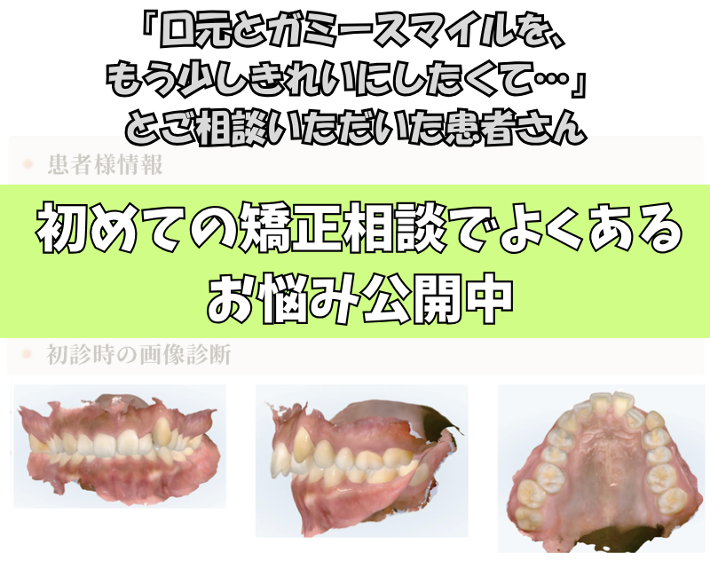 「口元とガミースマイルを、もう少しきれいにしたくて…」とご相談いただいたA.Mさん（26歳・女性）のケース