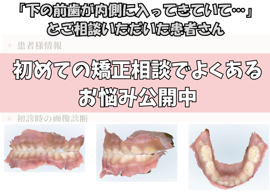 「下の前歯が内側に入ってきていて…」とご相談いただいたI.Yさん（6歳・男の子）のケース