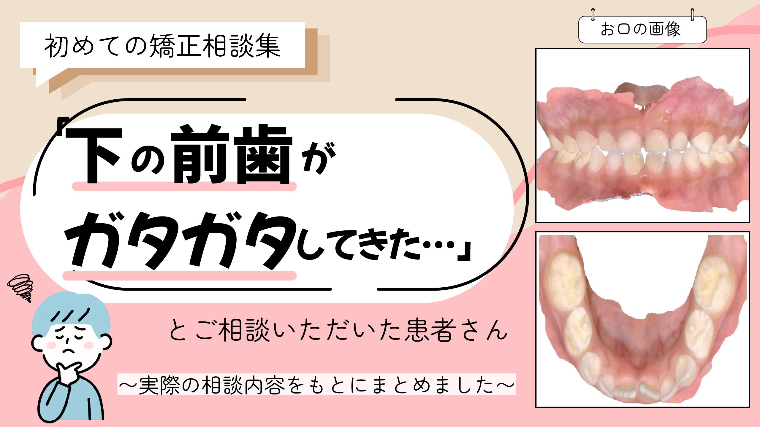 「下の前歯がガタガタしてきた…」とご相談いただいた S.Kさん（5歳・男の子）のケース