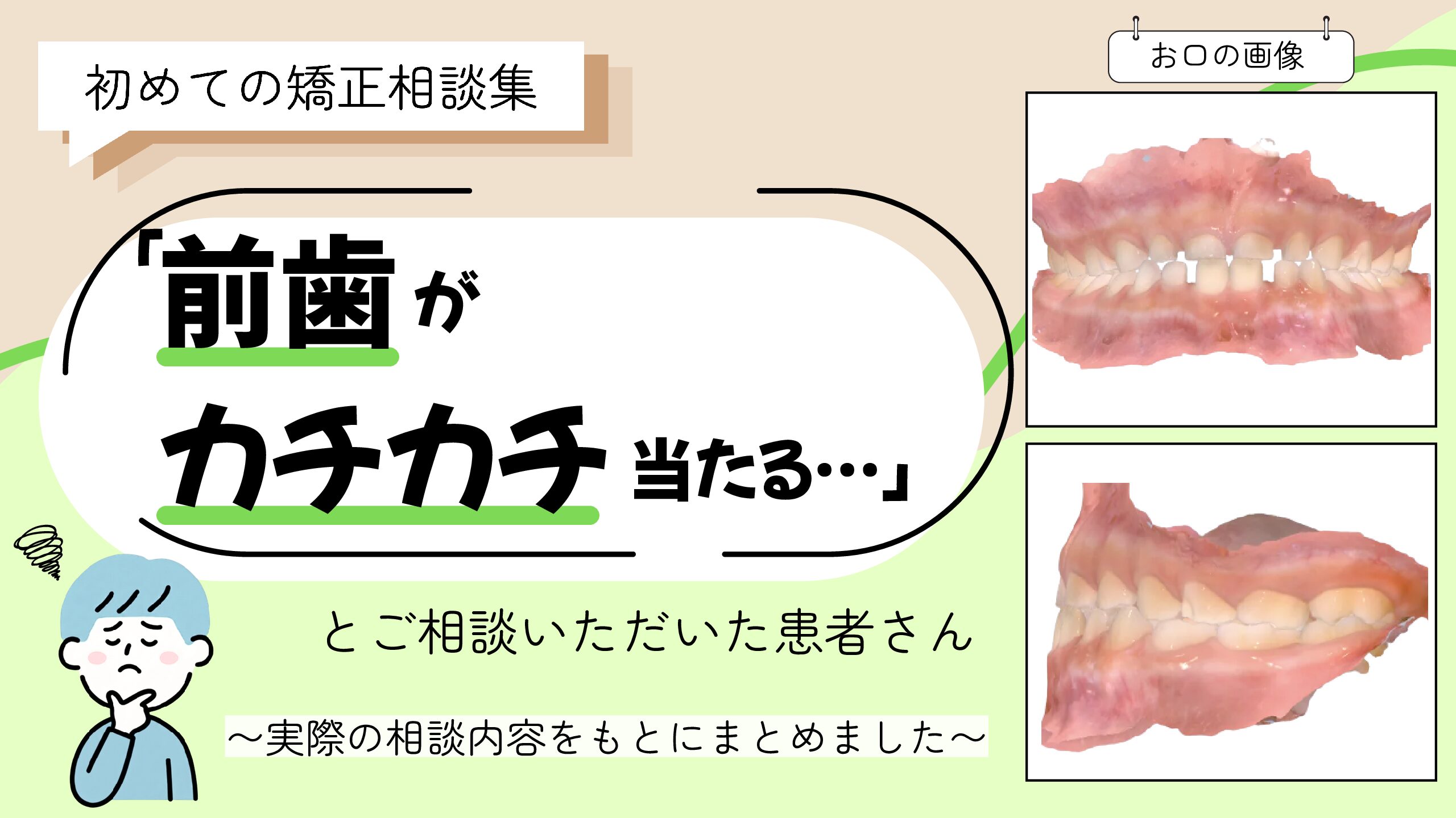 「前歯がカチカチ当たる…」とご相談いただいたS.Mさん（6歳・男の子）のケース