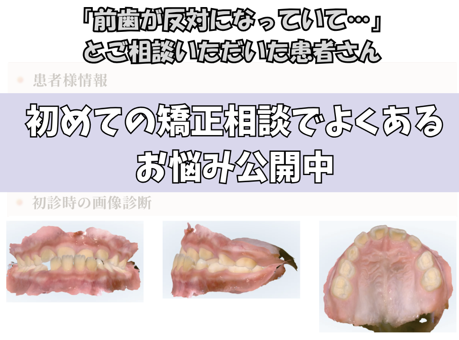 「前歯が反対になっていて…」とご相談いただいたA.Hさん（9歳・男の子）のケース