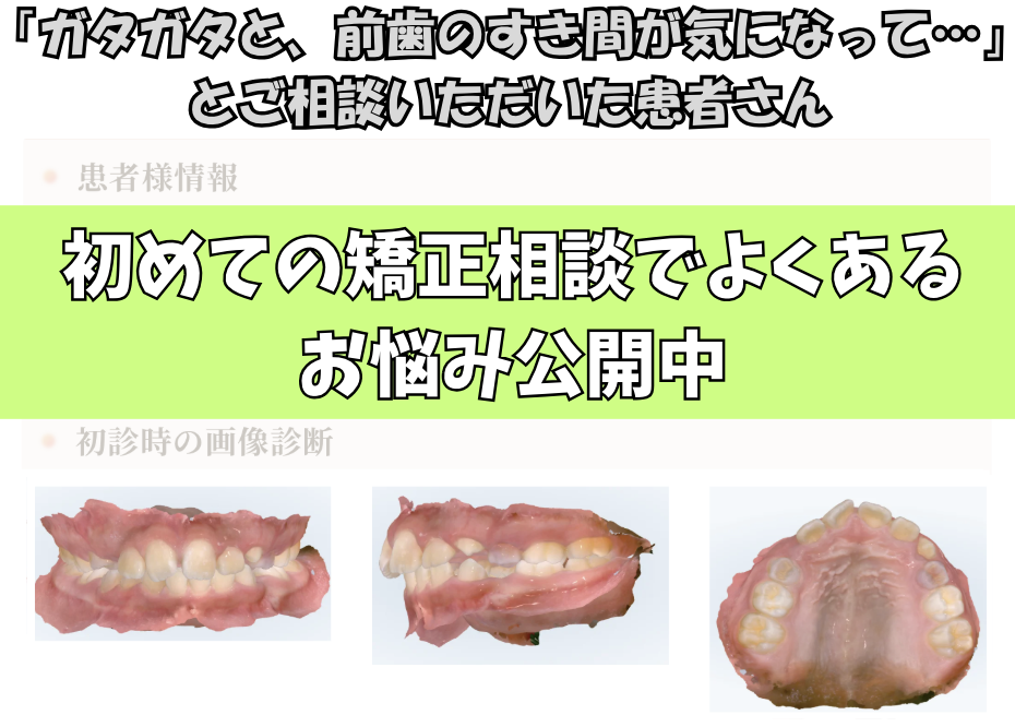 「ガタガタと、前歯のすき間が気になって…」とご相談いただいたH.Tさん（9歳・女の子）のケース