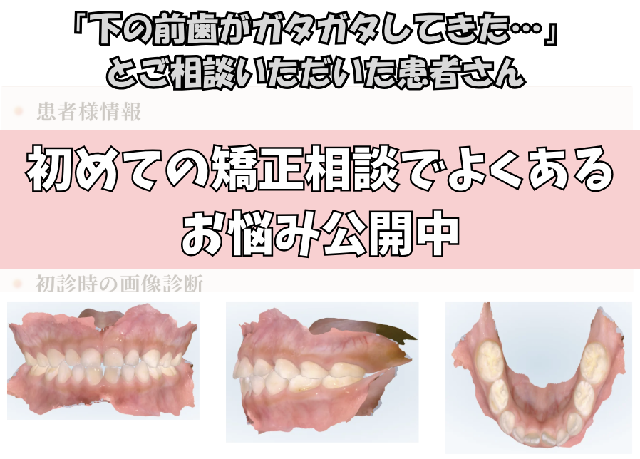 「下の前歯がガタガタしてきた…」とご相談いただいた S.Kさん（5歳・男の子）のケース