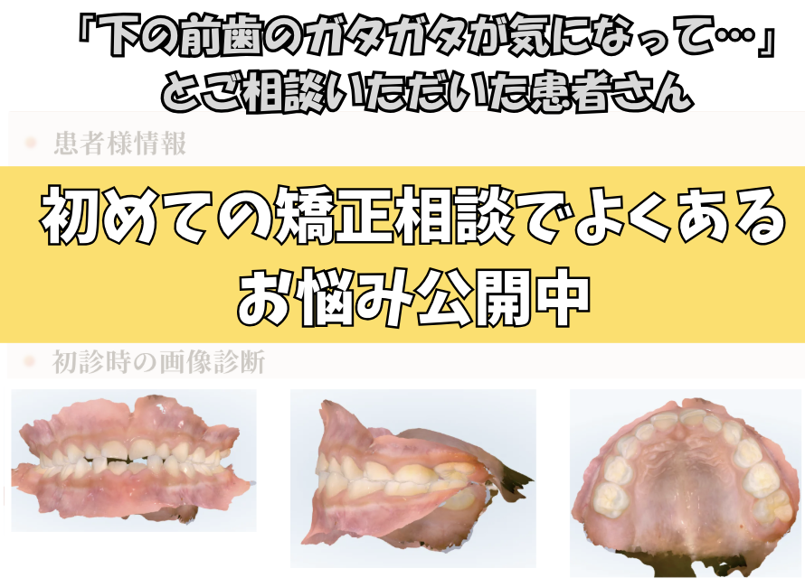 「下の前歯のガタガタが気になって…」とご相談いただいたN.Nさん（７歳・女の子）のケース