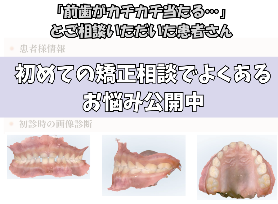 「前歯がカチカチ当たる…」とご相談いただいたS.Mさん（6歳・男の子）のケース