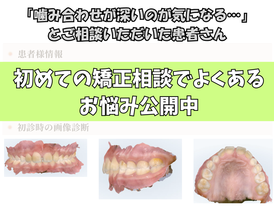 「噛み合わせが深いのが気になる…」とご相談いただいたS.Tさん（8歳・女の子）のケース