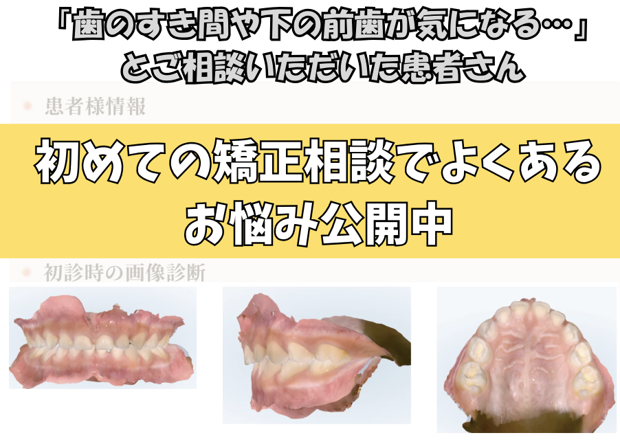 「歯のすき間や下の前歯が気になる…」とご相談いただいたS.Kさん（5歳・女の子）のケース