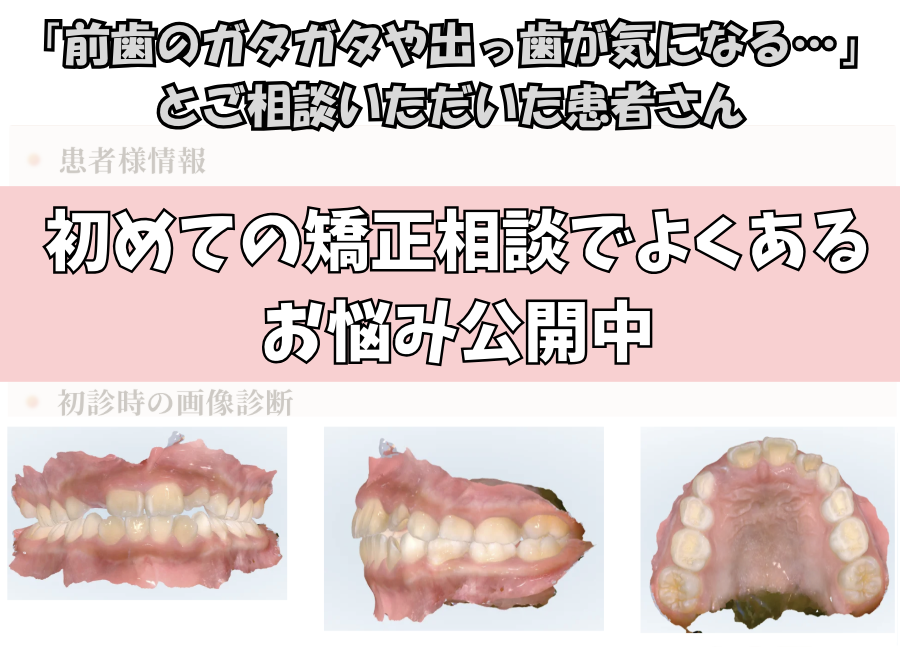 「前歯のガタガタや出っ歯が気になる…」とご相談いただいたY.Sさん（8歳・女の子）のケース