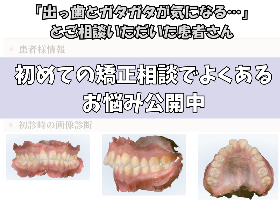 「出っ歯とガタガタが気になる…」とご相談いただいたY.Eさん（16歳・男性）のケース