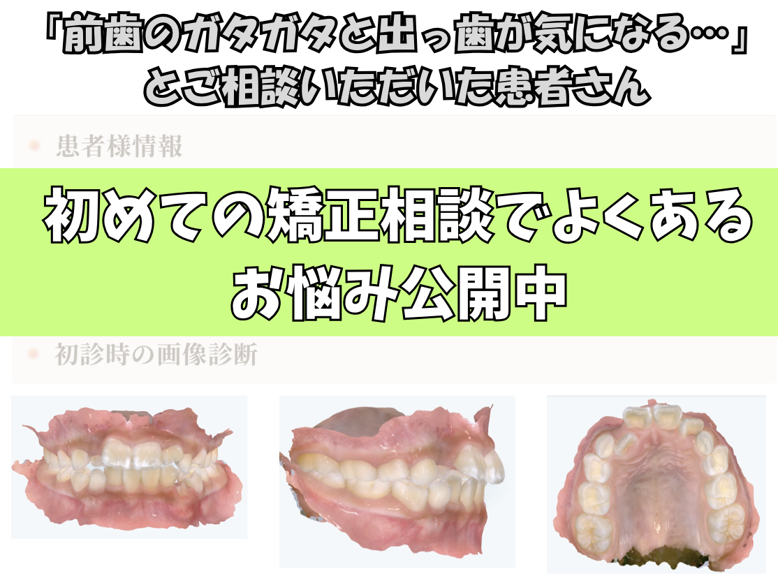 「前歯のガタガタと出っ歯が気になる…」とご相談いただいたK.Aさん（8歳女の子）のケース