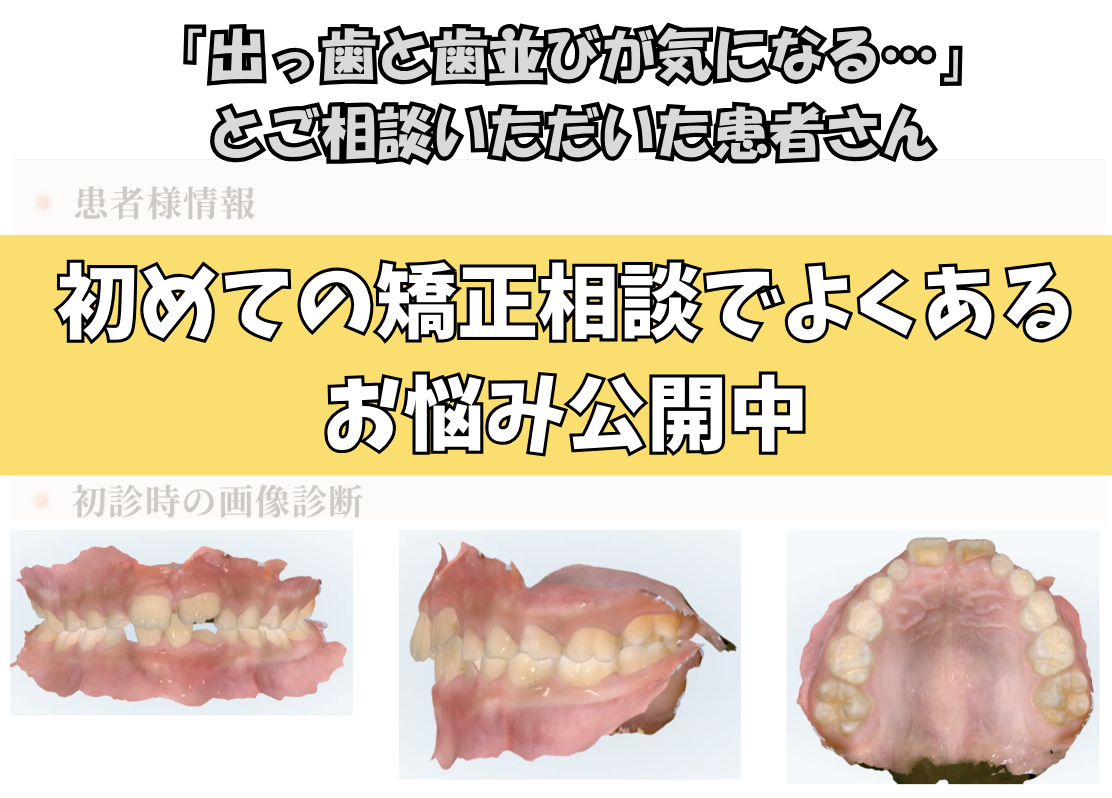 「出っ歯と歯並びが気になる…」とご相談いただいたA.Hさん（8歳・男の子）のケース