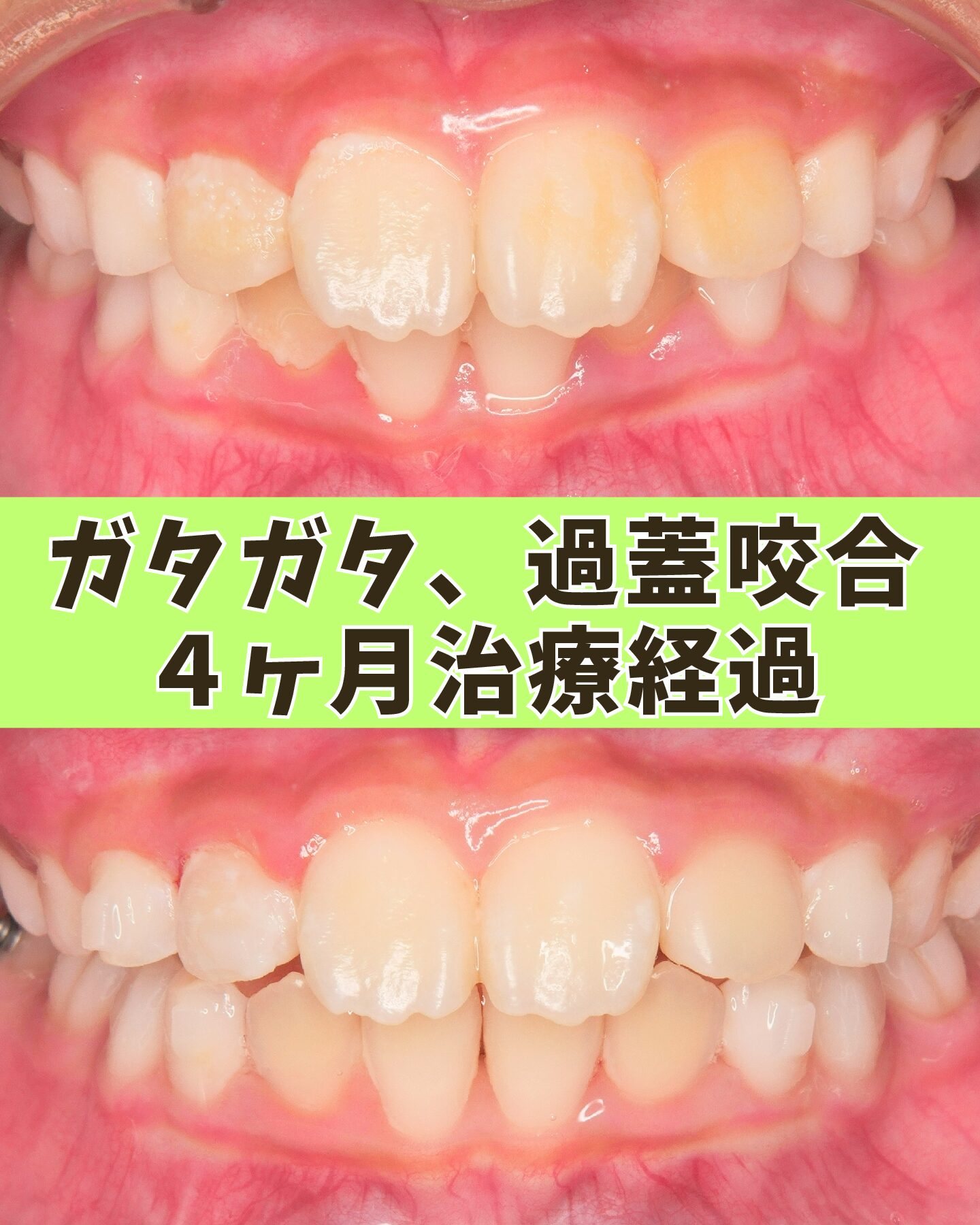 ８歳（治療経過）｜咬み合わせが深く、出っ歯とガタつきが気になっていたケース