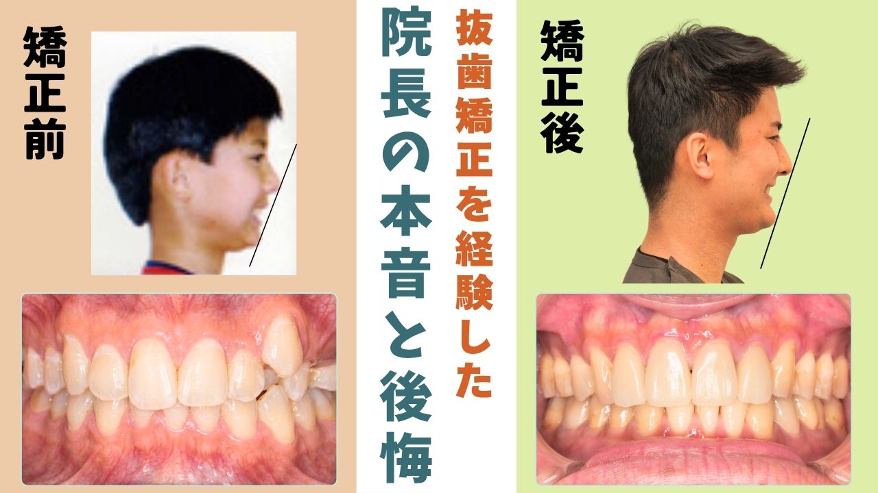 抜歯矯正を経験した矯正専門医院の院長の本音― 私自身の「後悔」から、これから矯正する方へ伝えたいこと ―