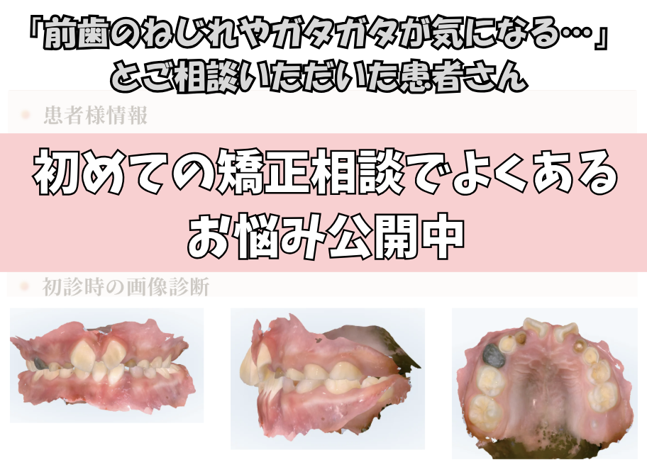 「前歯のねじれやガタガタが気になる…」とご相談いただいたH.Yさん（8歳 ・男の子）のケース