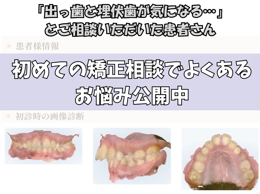 「出っ歯と埋伏歯が気になる…」とご相談いただいたH.Wさん（11歳・女の子）のケース