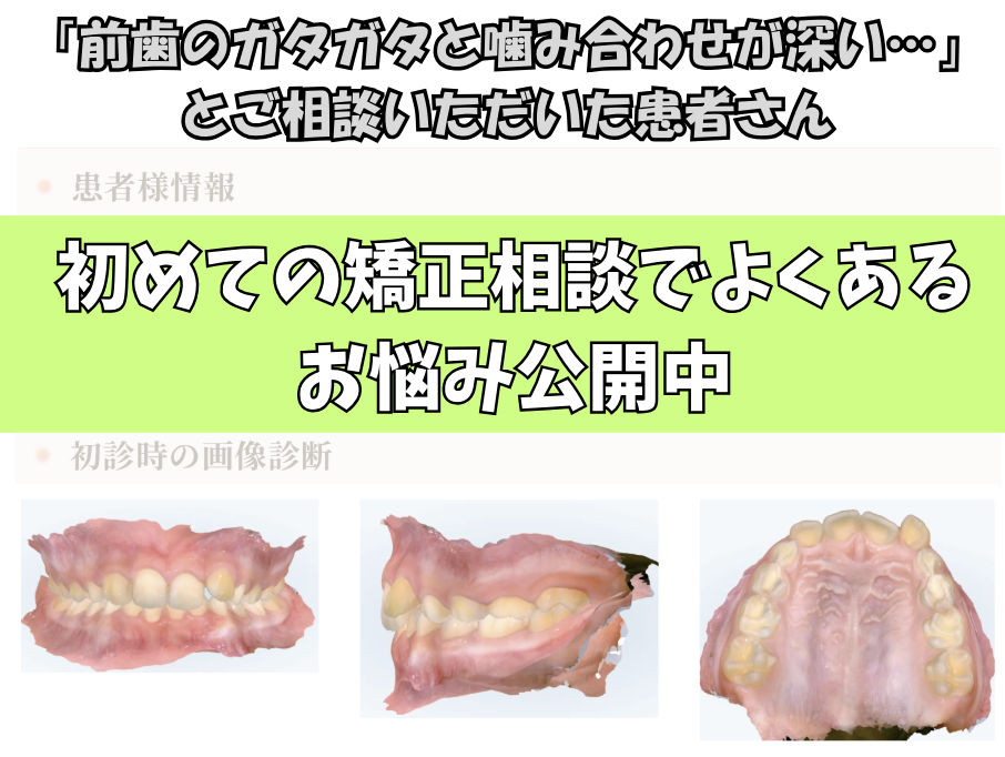 「前歯のガタガタと噛み合わせが深い…」とご相談いただいたH.Sさん（9歳・男の子）のケース