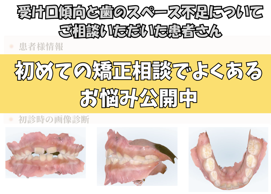 受け口傾向と歯のスペース不足についてご相談いただいたJ.Oさん（6歳・女の子）のケース
