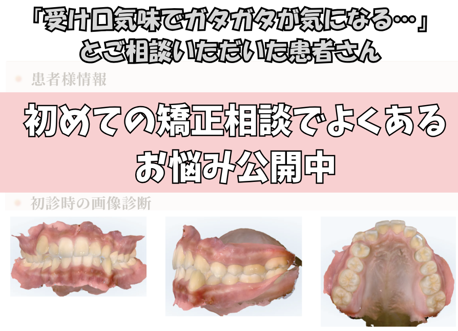「受け口気味でガタガタが気になる…」とご相談いただいたH.Tさん（13歳・女の子）のケース