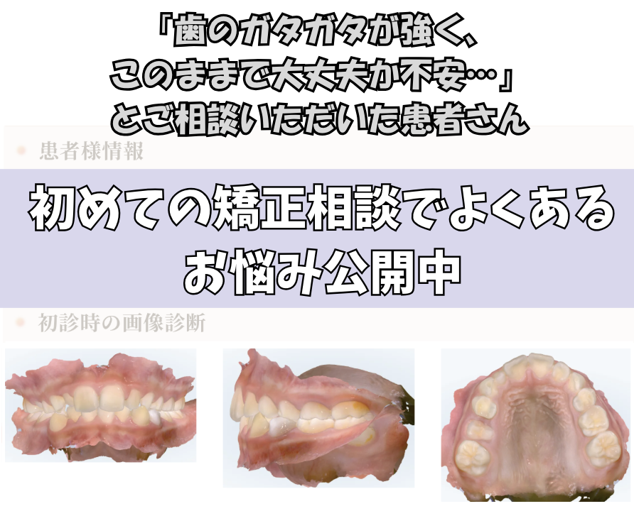 「歯のガタガタが強く、このままで大丈夫か不安…」とご相談いただいたS.Tさん（10歳・女の子）のケース
