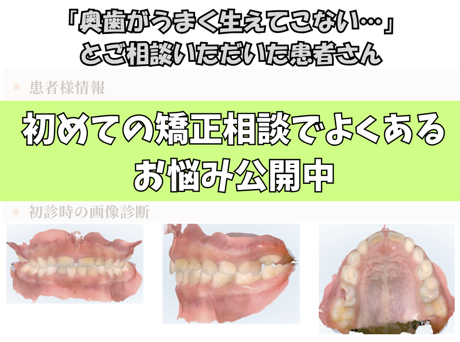 「奥歯がうまく生えてこない…」とご相談いただいたR.Sさん（6歳・女の子）のケース
