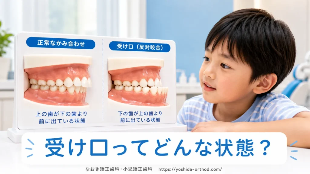 反対咬合（受け口）とは？子どもに見られる症状と特徴