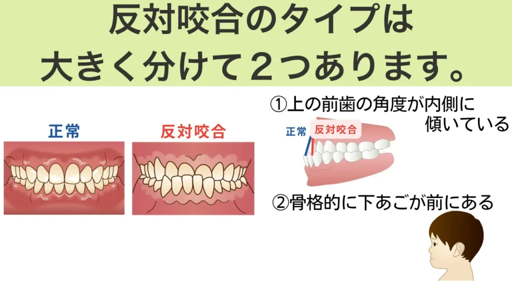 反対咬合の2つのタイプ：「歯の傾き」と「骨格のずれ」