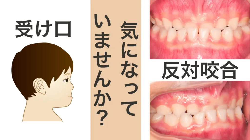 反対咬合（受け口）とは？子どもに見られる症状と特徴