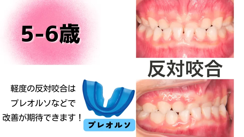 5〜6歳：骨格に原因がある場合は早期治療を検討する時期
