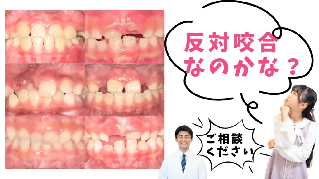 「うちの子、反対咬合かも？」と思ったときのセルフチェック