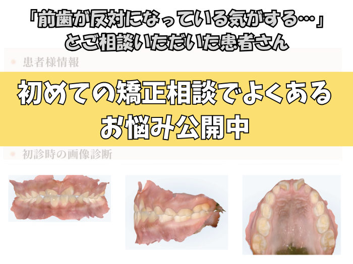 「前歯が反対になっている気がする…」とご相談いただいたA.Kさん（7歳・女の子）のケース