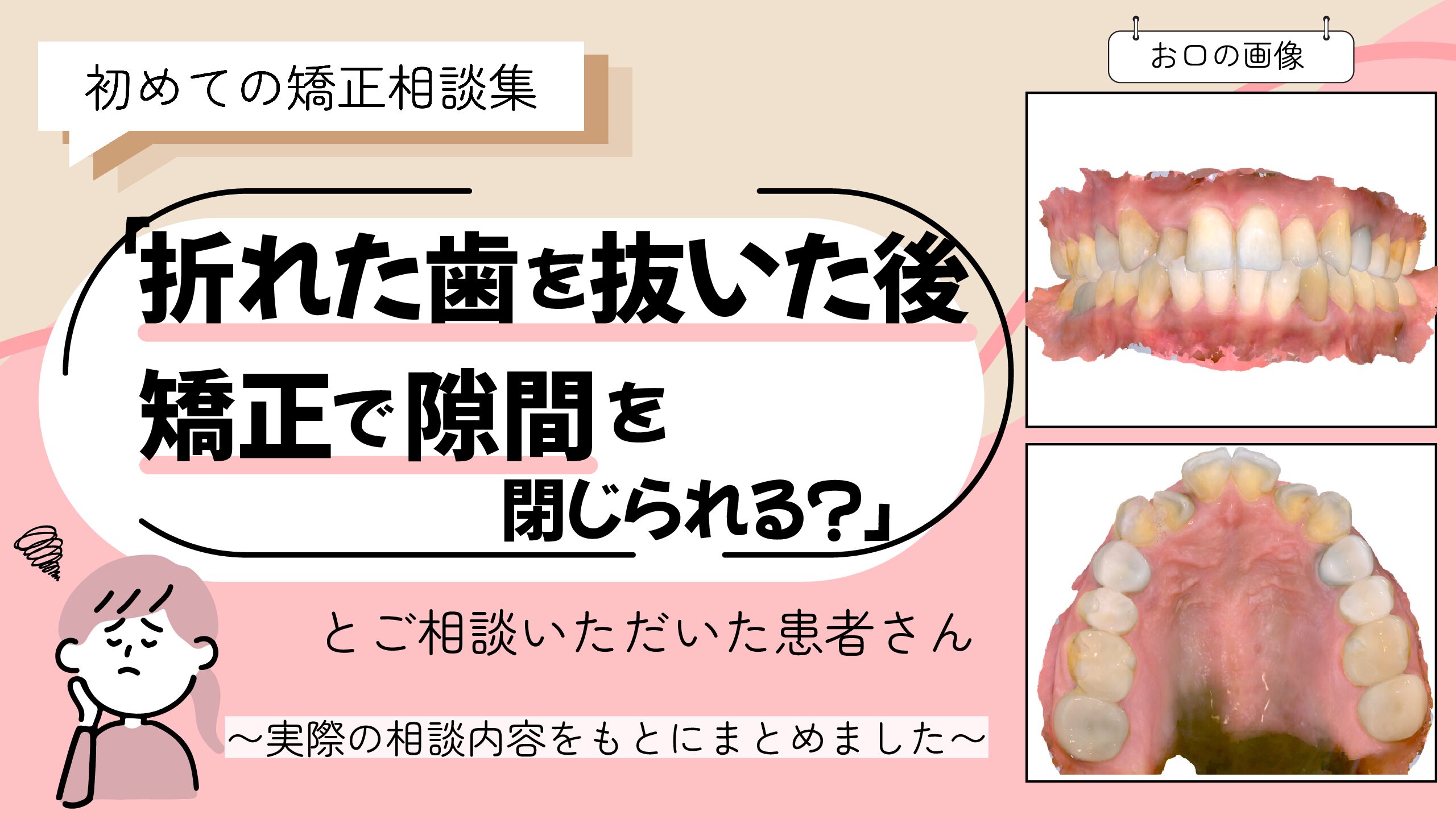 「折れた歯を抜いた後、矯正で隙間を閉じられる？」とご相談いただいたA.Uさん（44歳・女性）のケース